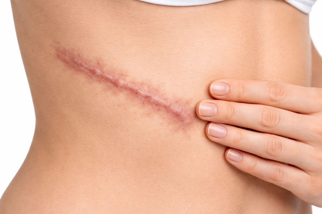 Blizna na boku kobiety, widoczna na tle jasnej skóry, z ręką delikatnie dotykającą jej krawędzi, ilustrująca proces gojenia po operacji.