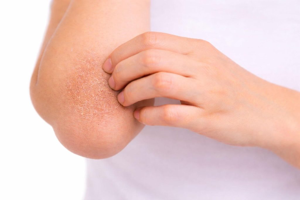 Skóra na łokciu z widocznymi objawami suchości i łuszczenia się, osoba drapiąca swój łokieć, co może sugerować problemy dermatologiczne, takie jak egzema lub łuszczyca.