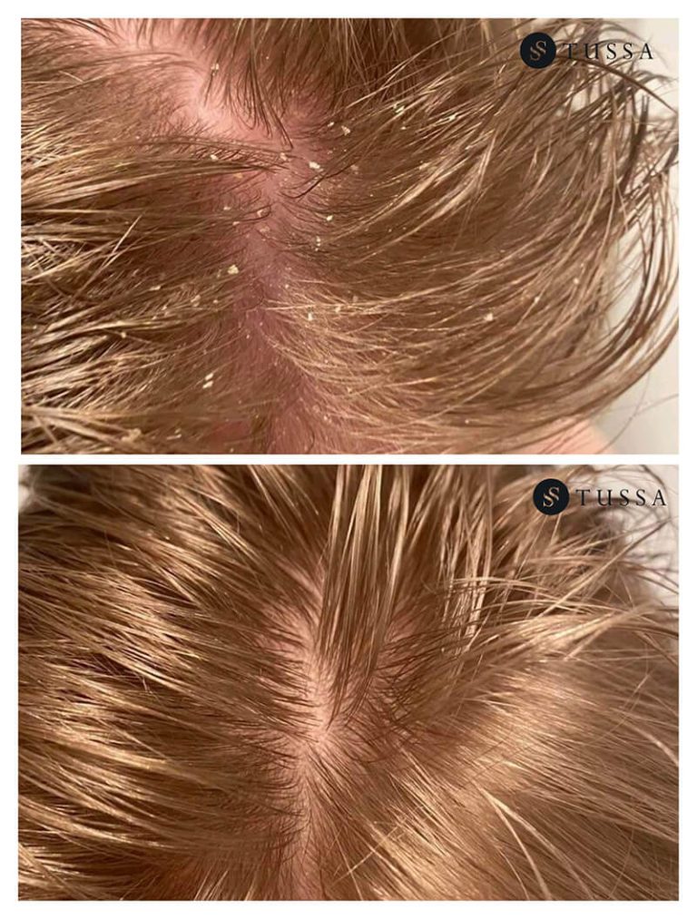 Skóra głowy z widocznymi łupieżem, pokazująca blondu fryzurę i drobne płatki na włosach. Idealne zdjęcie do omówienia problemów ze zdrowiem skóry głowy.