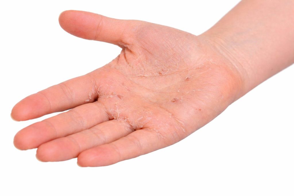 Złuszczona skóra na dłoni, widoczna z bliska, ukazująca oznaki podrażnienia i suchości.