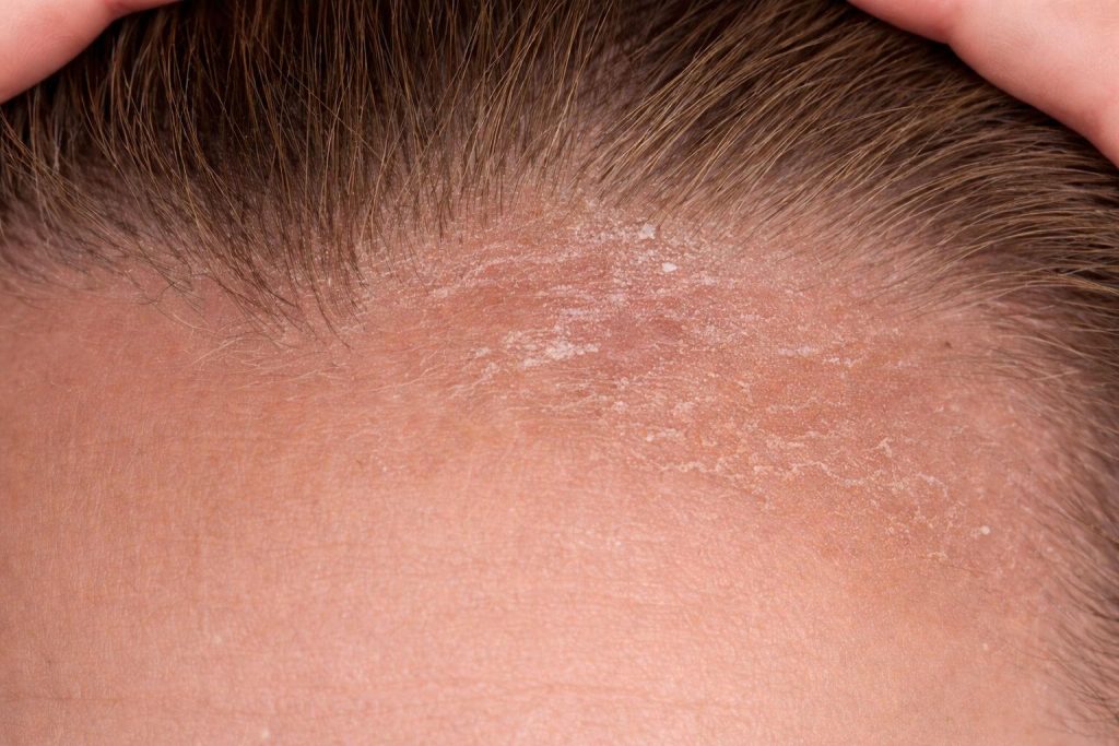 Skóra głowy z widocznymi suchymi plamami i łuszczeniem, co może sugerować problemy dermatologiczne, takie jak łupież czy egzema.
