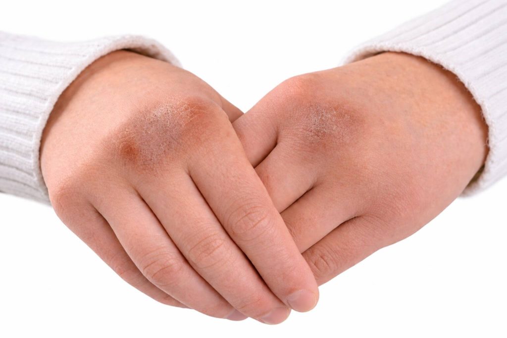 Dwie dłonie trzymające się nawzajem, z widocznymi oznakami suchości i zrogowacenia na skórze, na tle białym.