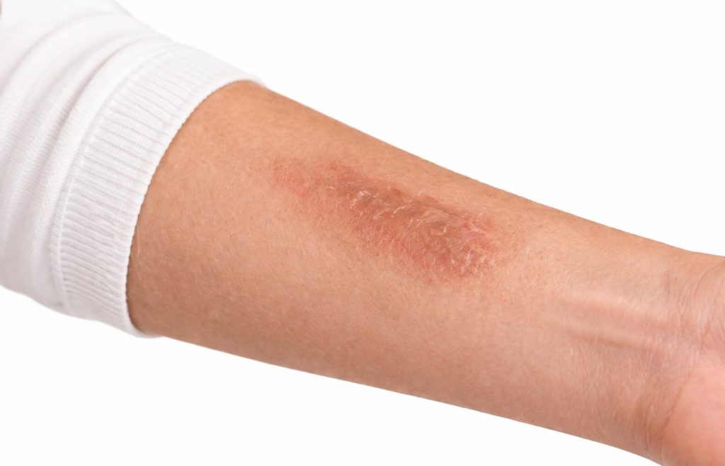 Oparzenie na przedramieniu z widocznymi oznakami gojenia, w tym zaczerwienieniem i spękaniami skóry. Idealne do ilustracji problemów skórnych i metod leczenia oparzeń.