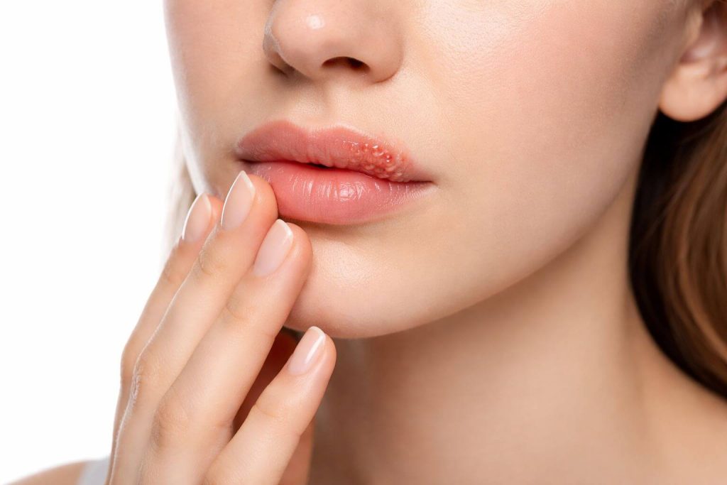 Kobieta z podrażnionymi wargami, delikatnie dotykająca ust, z widocznymi objawami na dolnej wardze. Zdjęcie ukazuje bliskość twarzy oraz stan skóry wokół ust, co może sugerować problemy dermatologiczne.